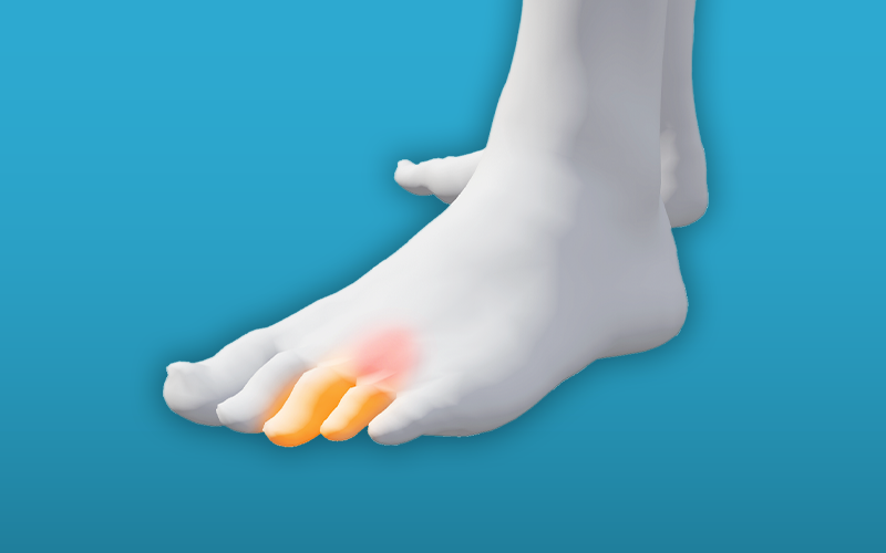 Neuroma Neuroma