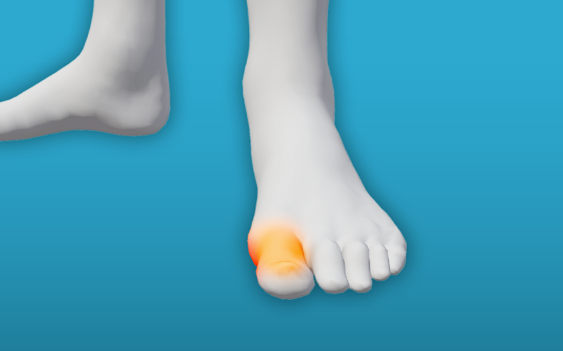Osteoarthritis-of-the-big-toe