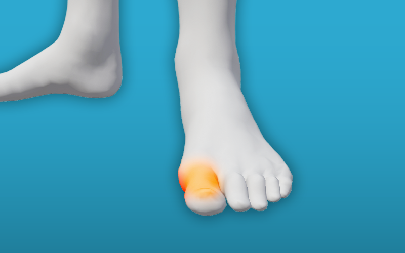 Osteoarthritis-of-the-big-toe-hallux-rigidus Osteoarthritis-of-the-big-toe