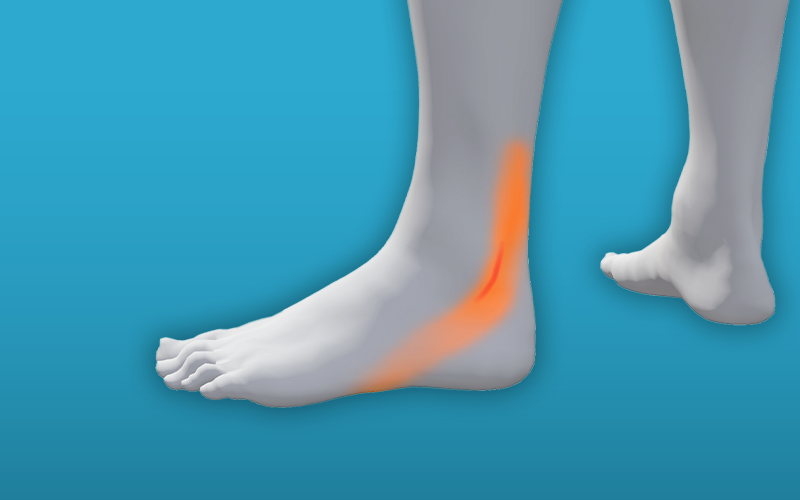 Peroneal tendinopathy